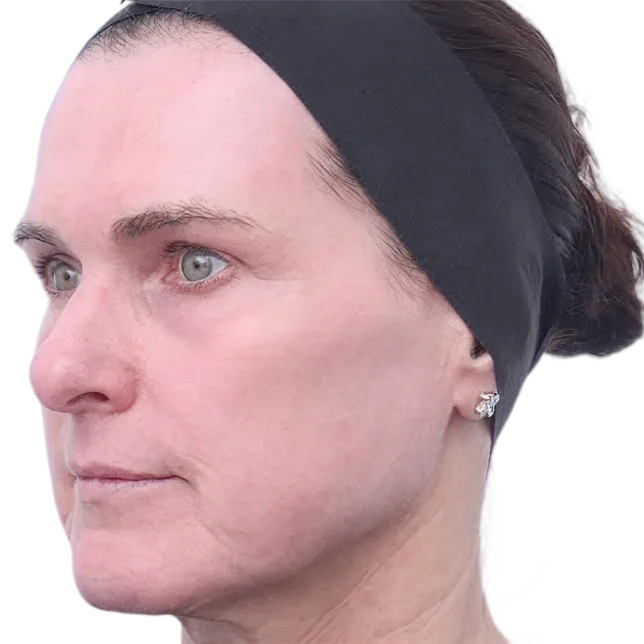 After treatment