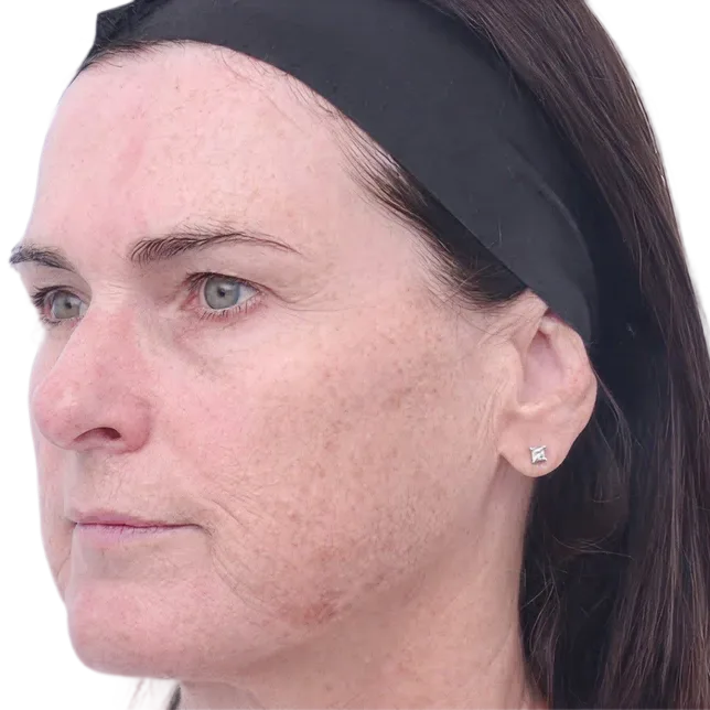 Before treatment
