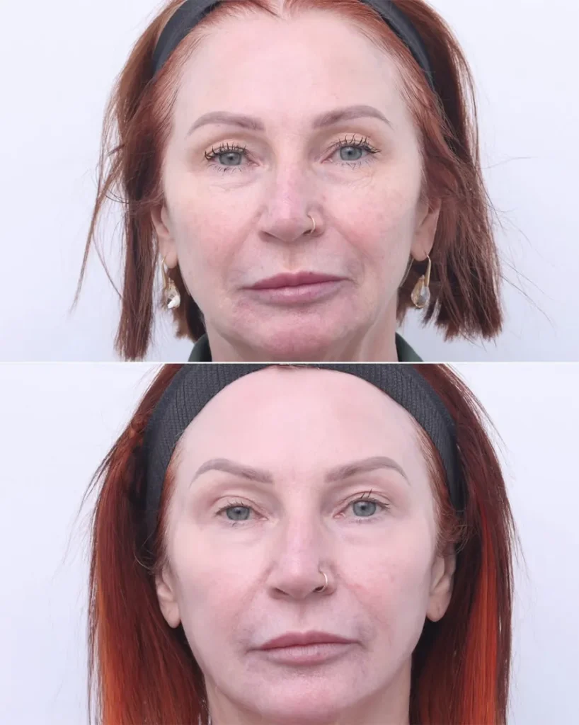 Before and after treatment for Skin Laxity