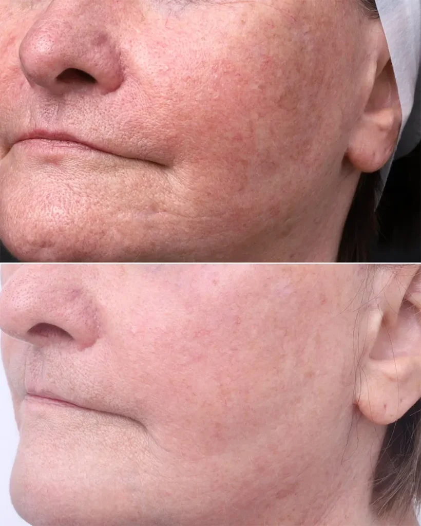 Before and after treatment for Redness