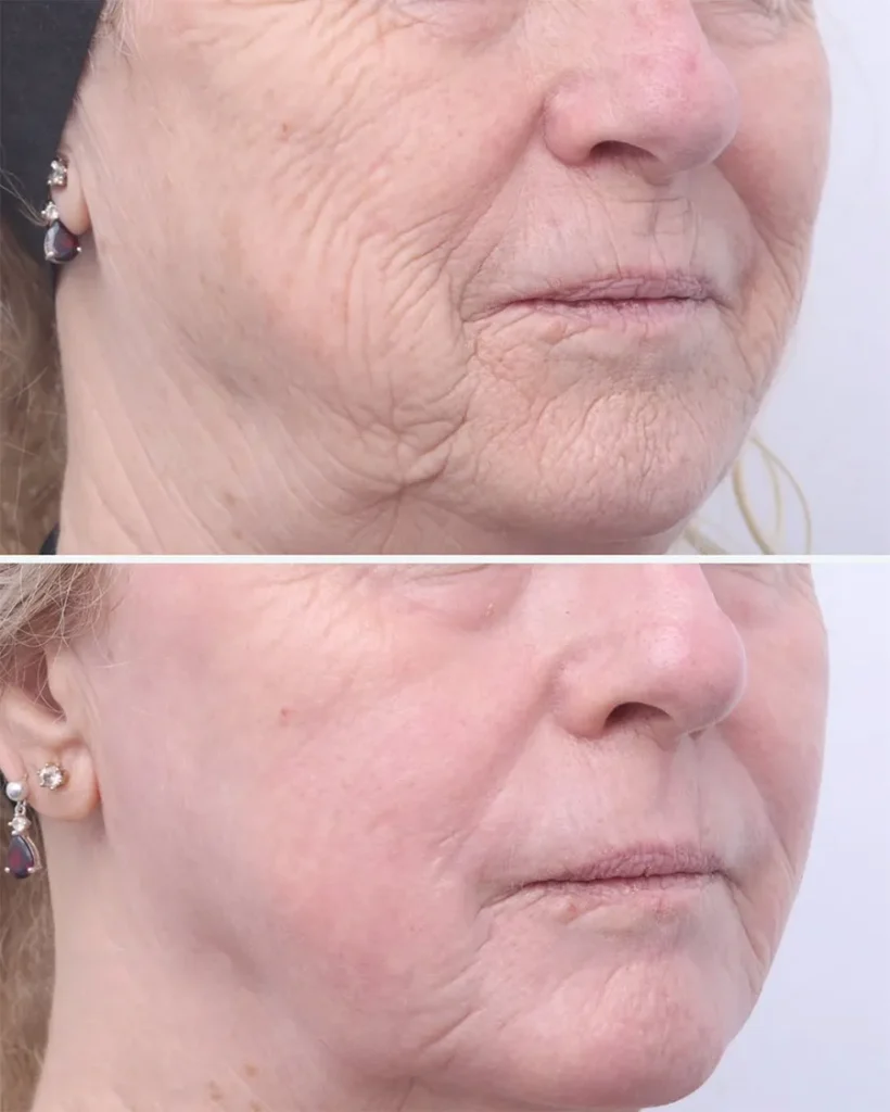 Before and after treatment for Wrinkles