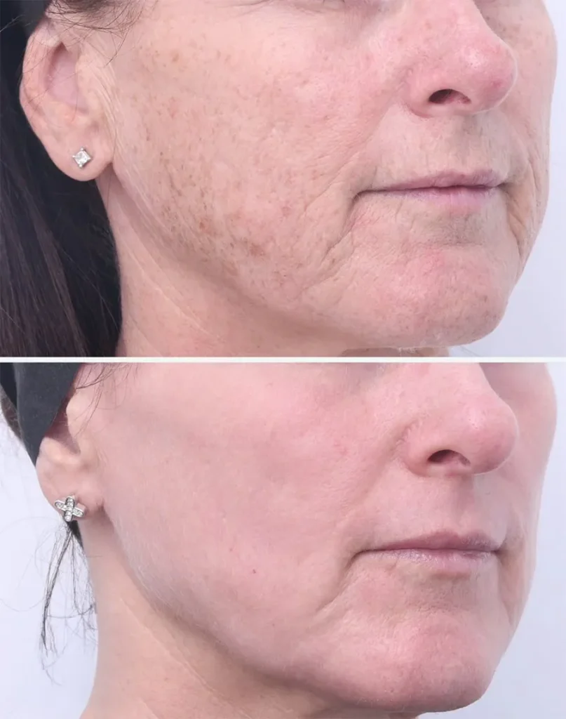 Before and after treatment for Pigmentation