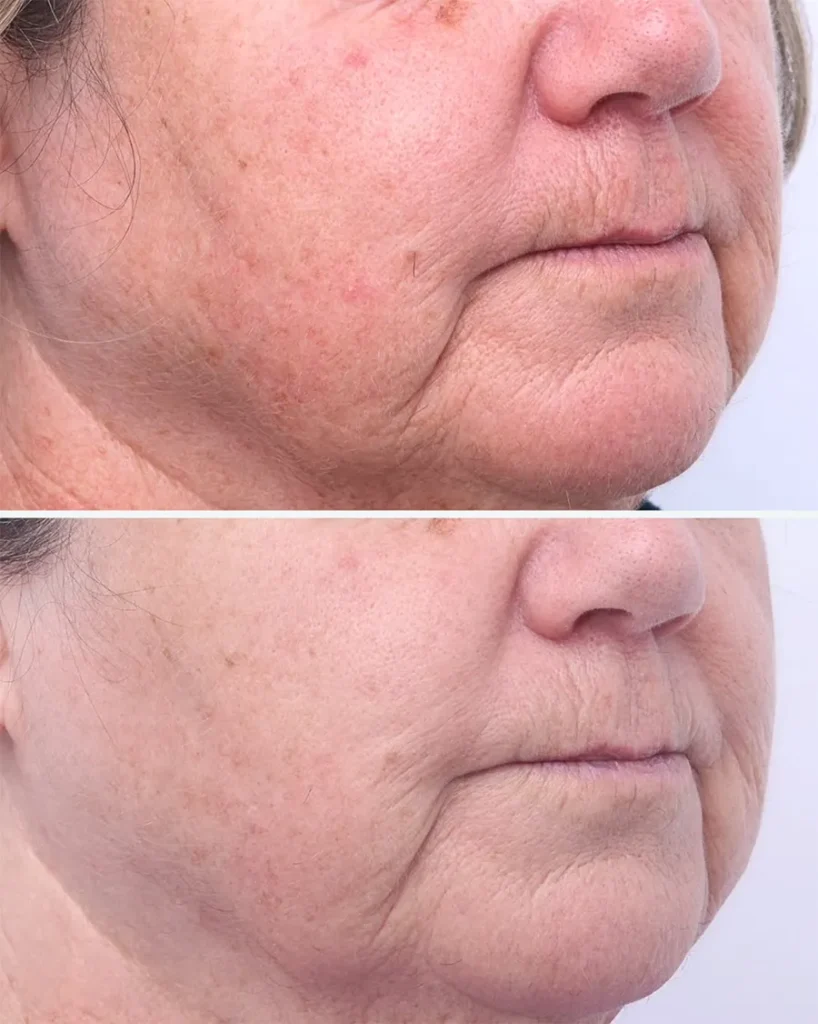 Before and after treatment for Pigmentation