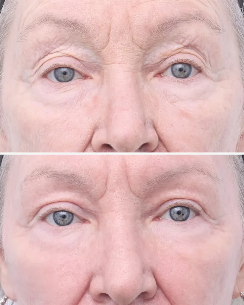 Before and after treatment for Skin Laxity