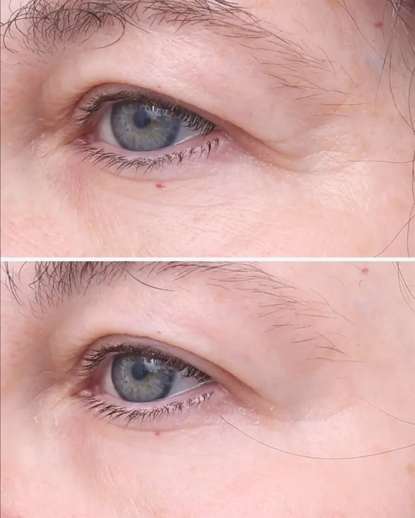 Before and after treatment for Skin Laxity