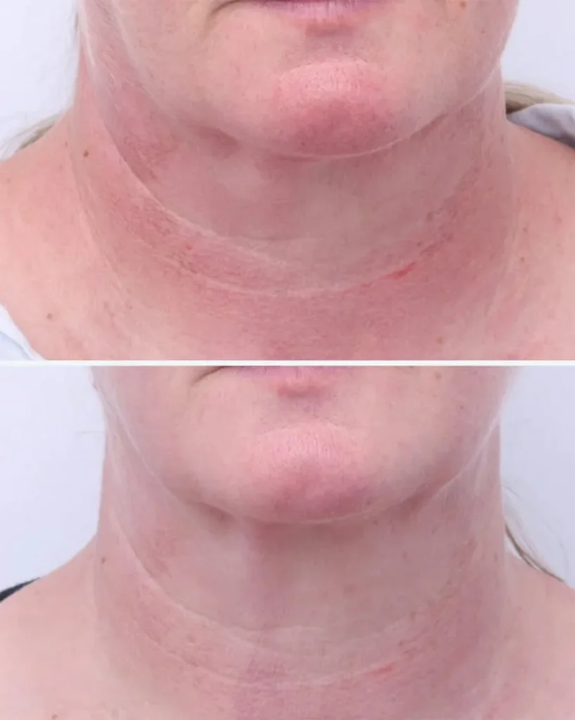 Before and after treatment for Redness