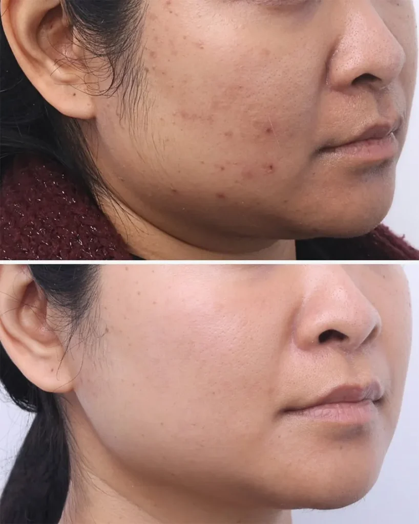 Before and after treatment for Acne Scarring